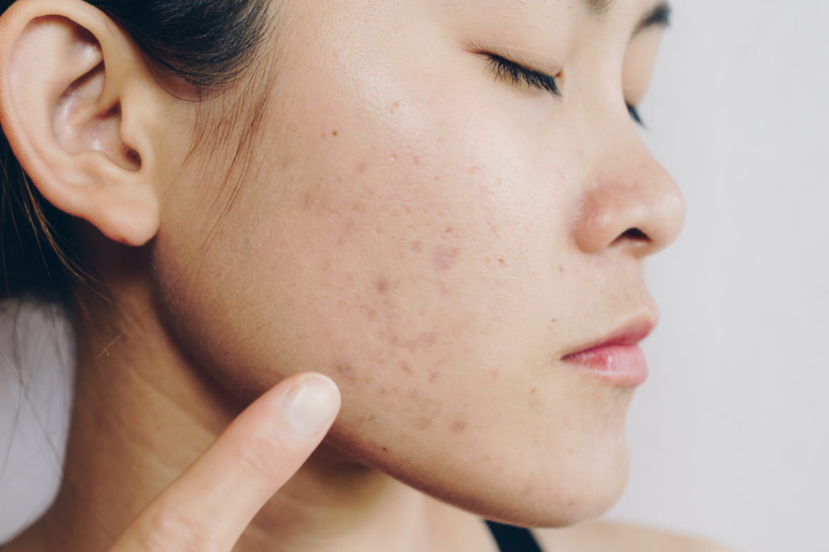 How To Avoid And Treat Unsightly Acne Scars Banner Health