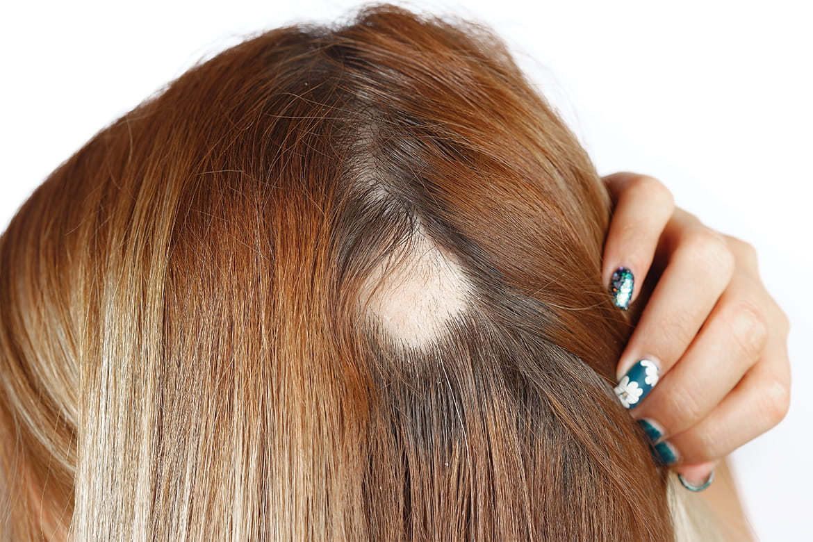 retirarse salida tonto Alopecia Areata – Causas, Síntomas y Opciones para su Tratamiento | Banner