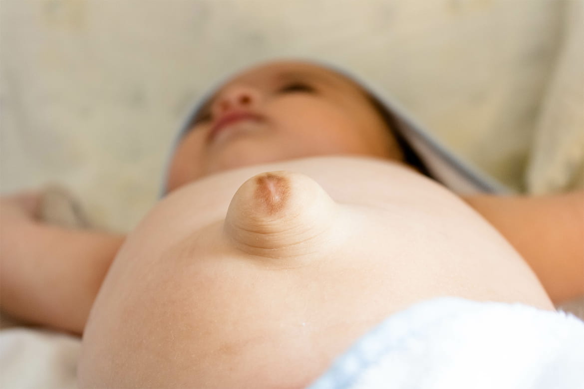 Umbilical hernia in babies-what is it? Does it need any treatment